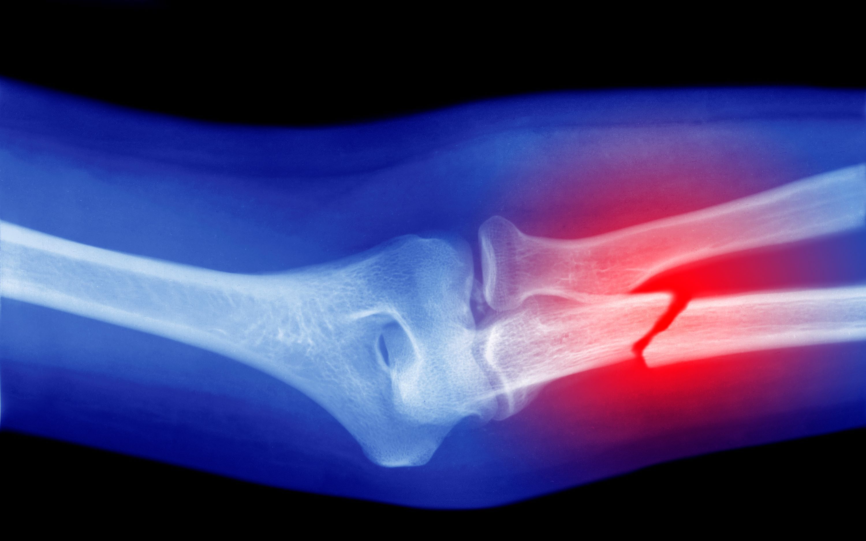 Microplastics Could Be Weakening Your Bones, Research Suggests